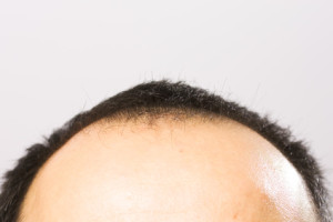 Mann mit Halbglatze vor der Haartransplantation